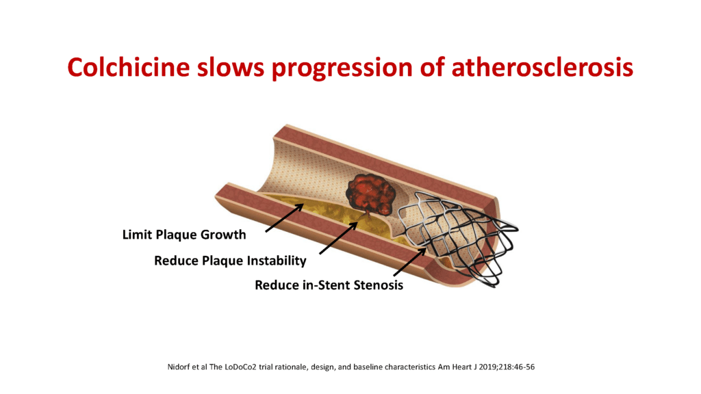 Scientific diagram depicting progression of atherosclerosis, now treatable with low doses of gout medication colchicine