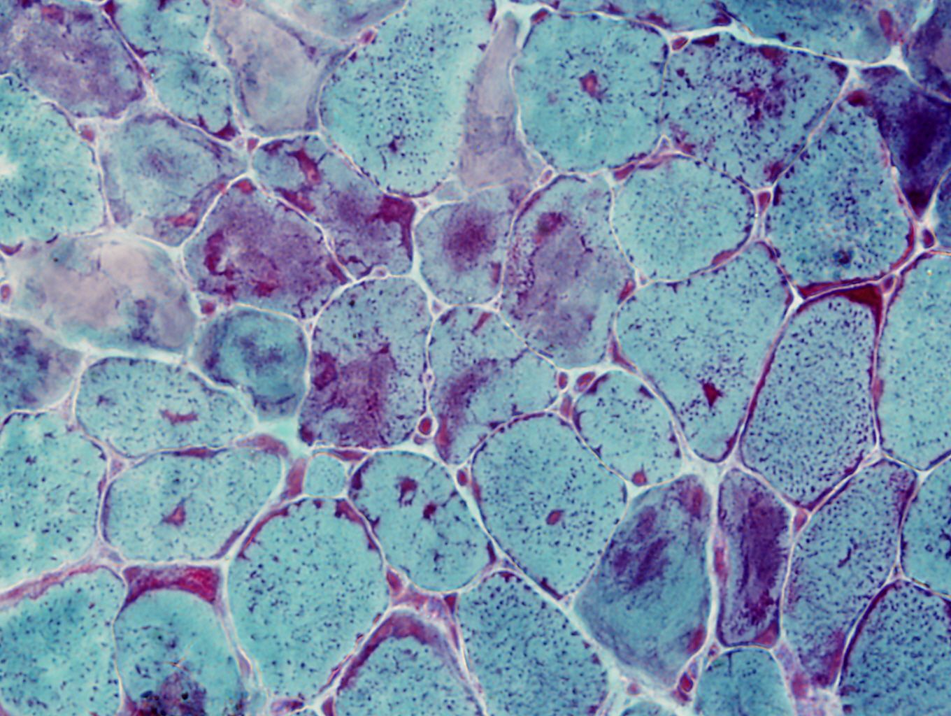 Gomori trichrome staining of skeletal muscle from a mouse with a congenital myopathy. The dark blue and purple regions show abnormal accumulations of proteins.